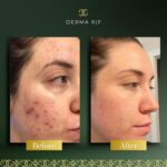 Derma Before and afters - RF