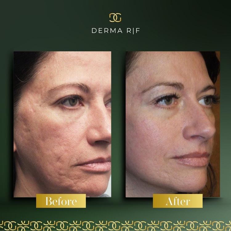 Derma Before and afters - RF (2)