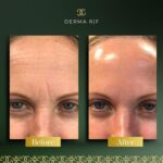 Derma Before and afters - RF (3)