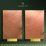 Derma Before and afters - RF (4)