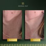 Derma Before and afters - RF